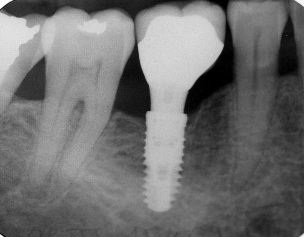 Radiographie d'implant molaire